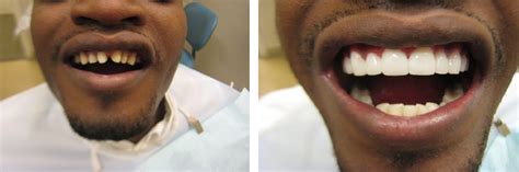 how much are the cheapest veneers